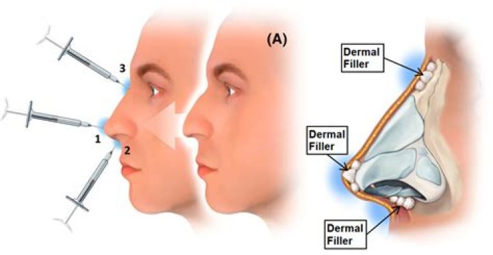 Is there a permanent filler for the nose?