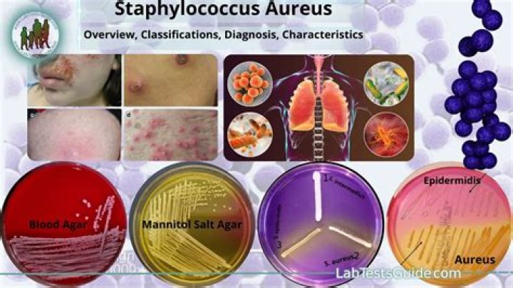 What are the main causes of Staphylococcus aureus?