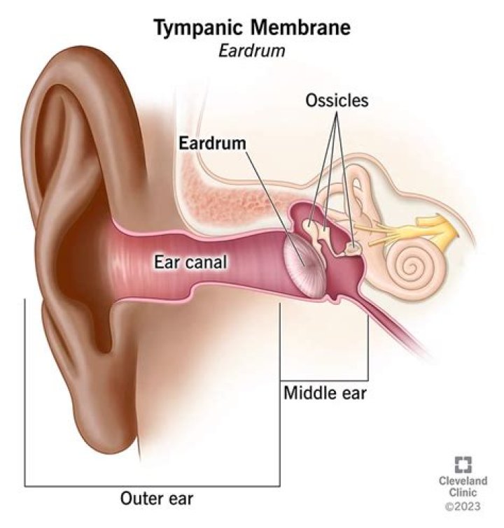 What causes a cyst in the ear canal?