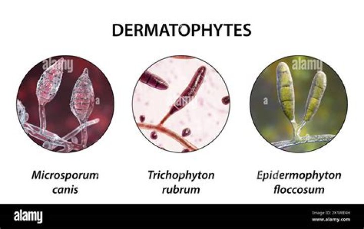 What causes dermatophytes?