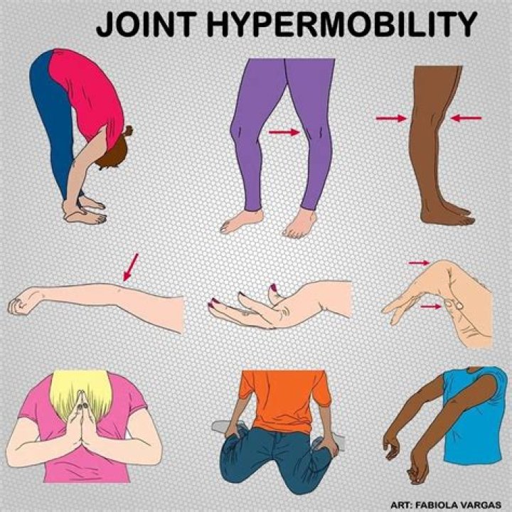 What disorders are associated with hypermobility?
