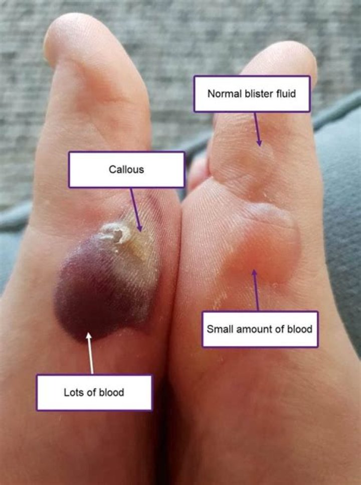 What do blood blisters look like on toes?