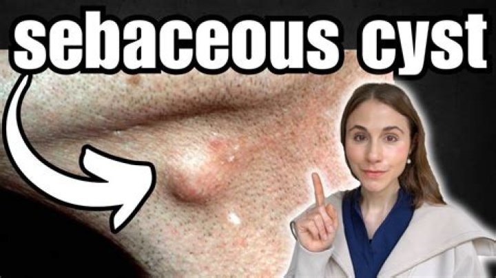 What does a vulvar sebaceous cyst look like?