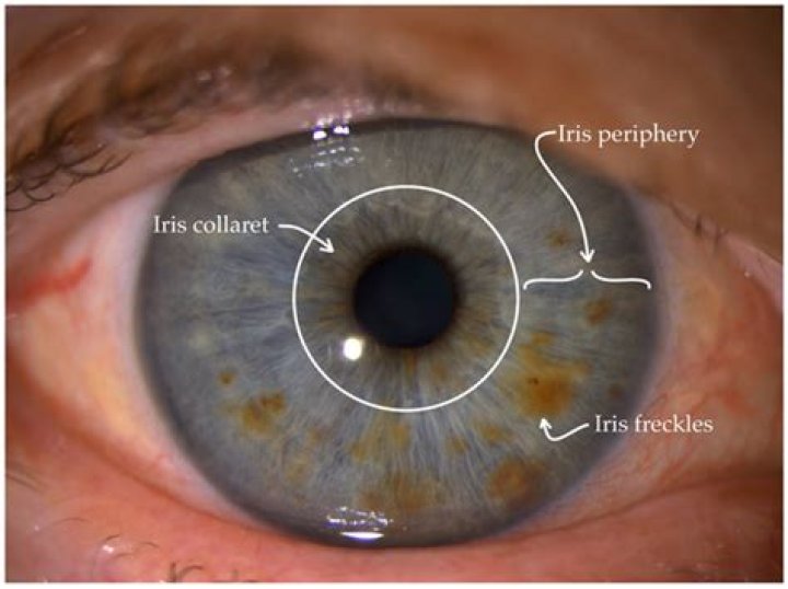 What does iris melanoma look like?