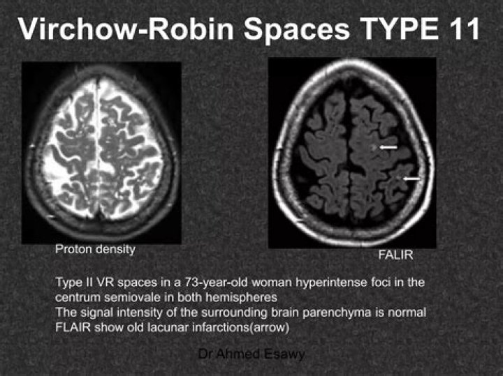 What does prominent Virchow Robin space mean?