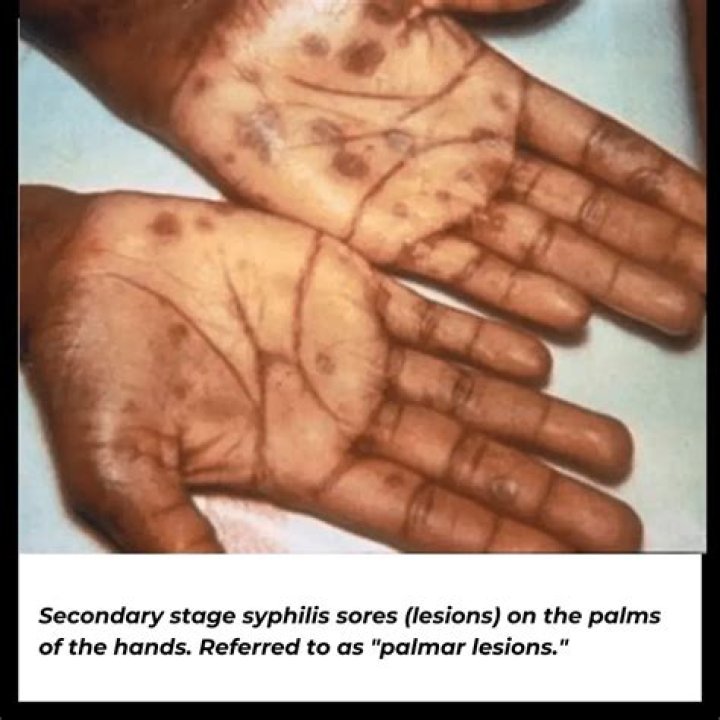 What does secondary syphilis rash look like?