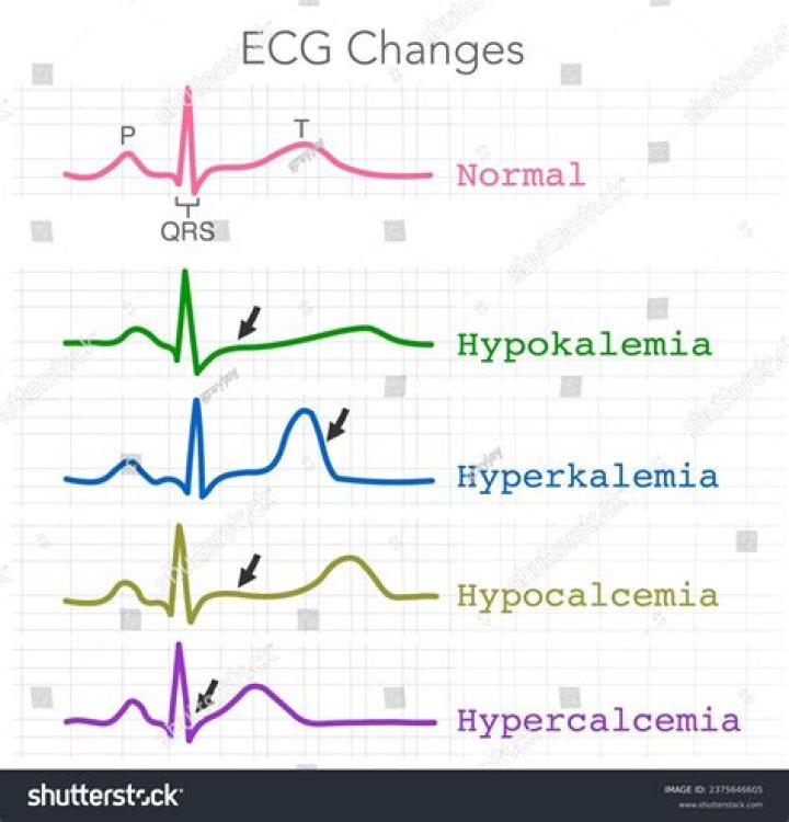 What ECG findings can be seen in hypocalcemia?