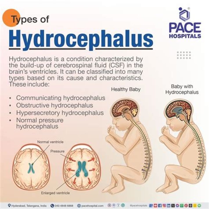 What gene causes hydrocephalus?