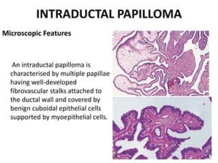 What happens if intraductal papilloma is not treated?