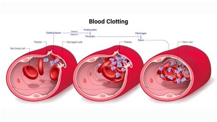 What happens if you have a blood clot in your portal vein?