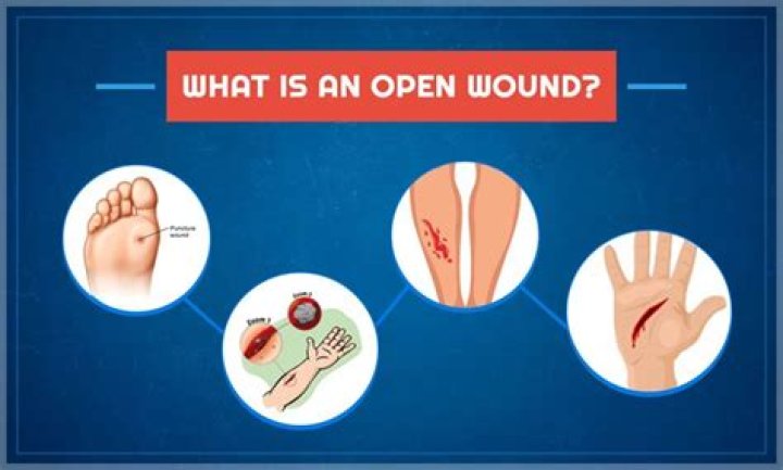What helps open wounds heal faster?