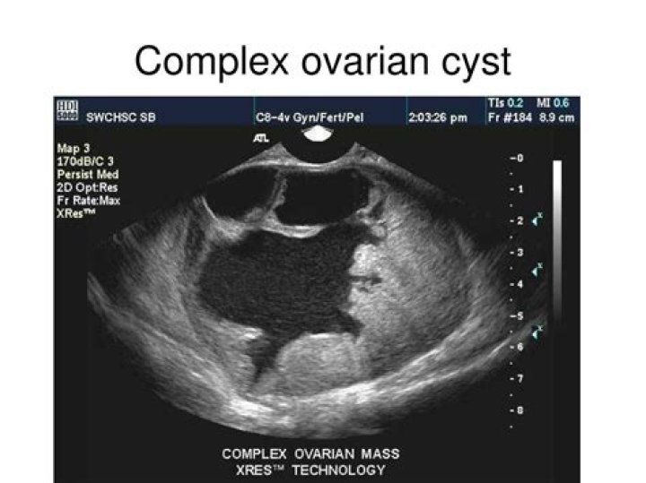 What is a mildly complex ovarian cyst?