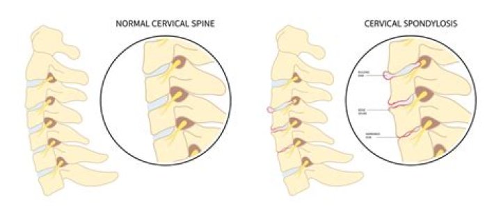 What is a normal cervical spine?