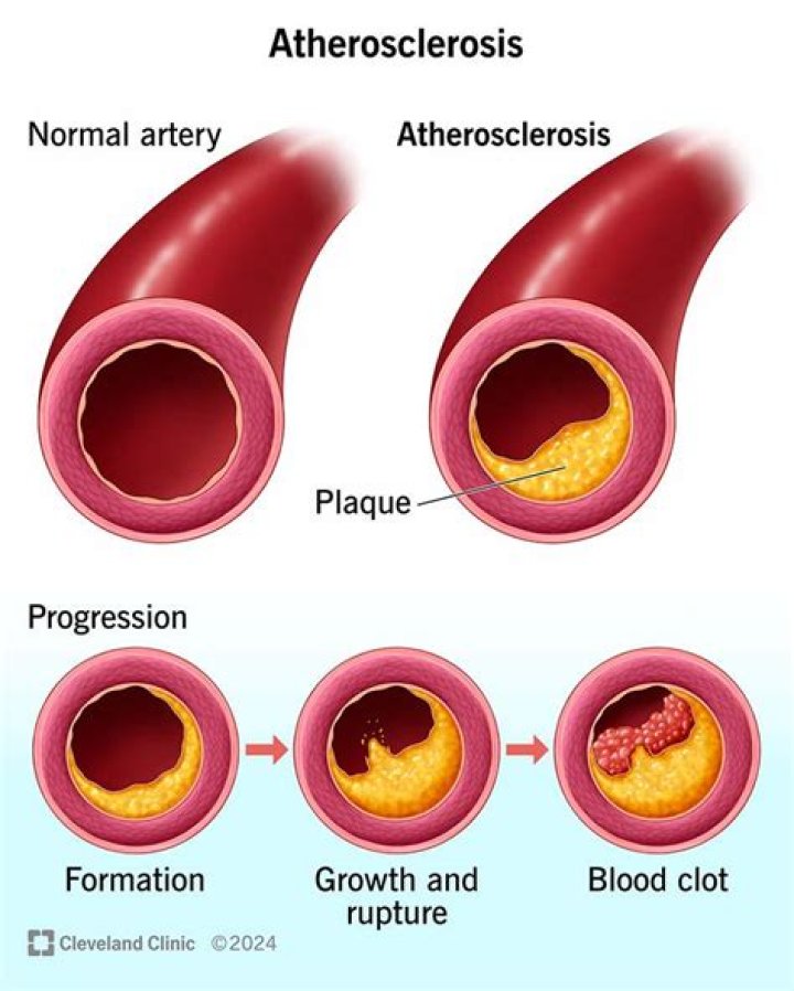 What is atherosclerosis obliterans?