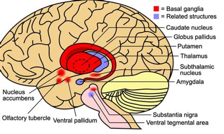 What is basal ganglia lacunar infarct?