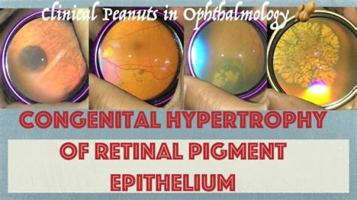 What is congenital hypertrophy of retinal pigment epithelium?