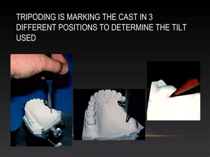 What is dental Tripoding?