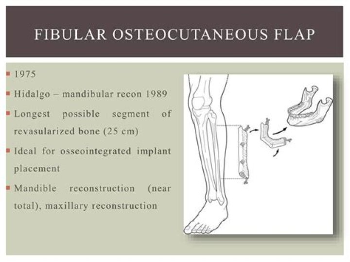 What is fibula free flap?