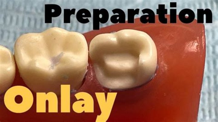 What is inlay preparation?