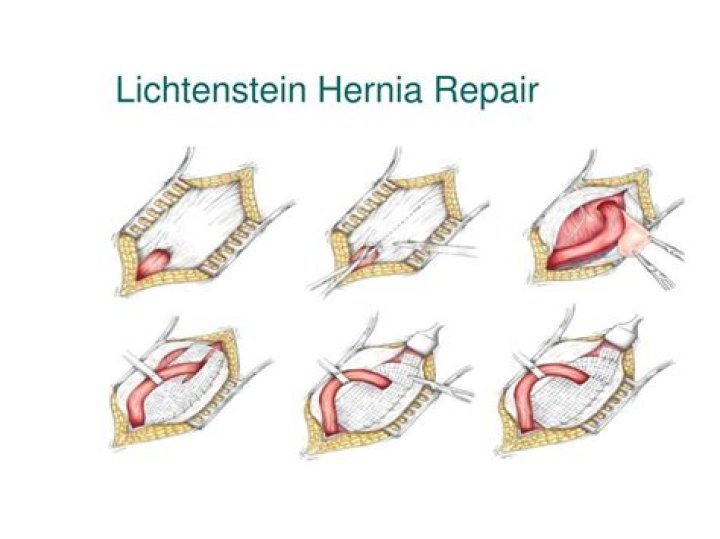 What is Lichtenstein procedure?