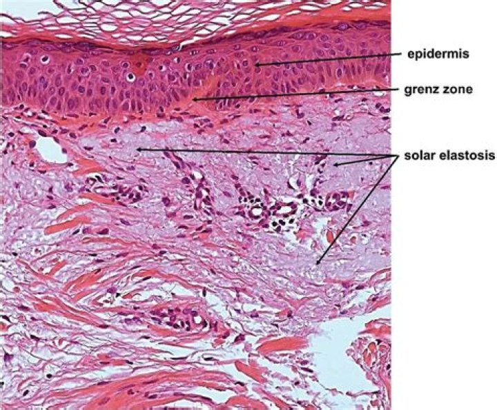 What is solar elastosis?