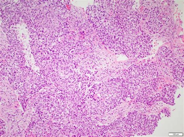 What is squamous cell carcinoma of retromolar Trigone?