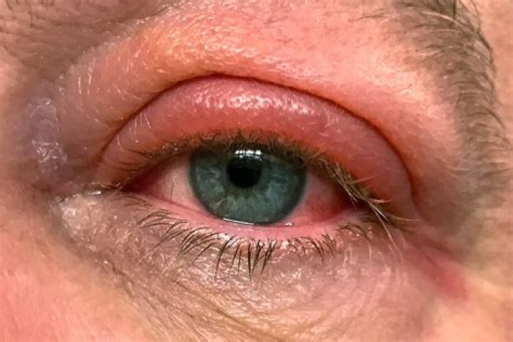 What is the fastest way to heal a swollen eyelid?