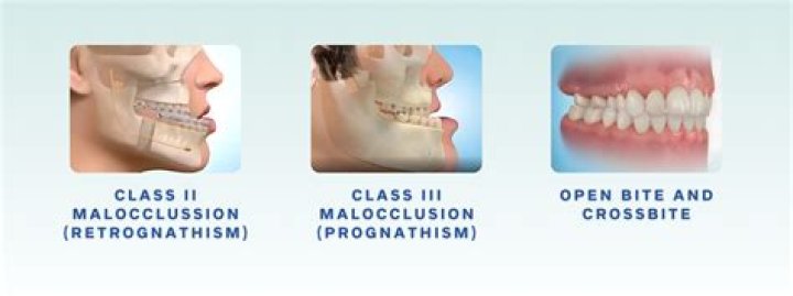 What is the most effective treatment for malocclusion?