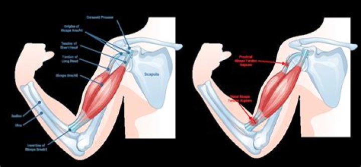 What is the rupture of a muscle?