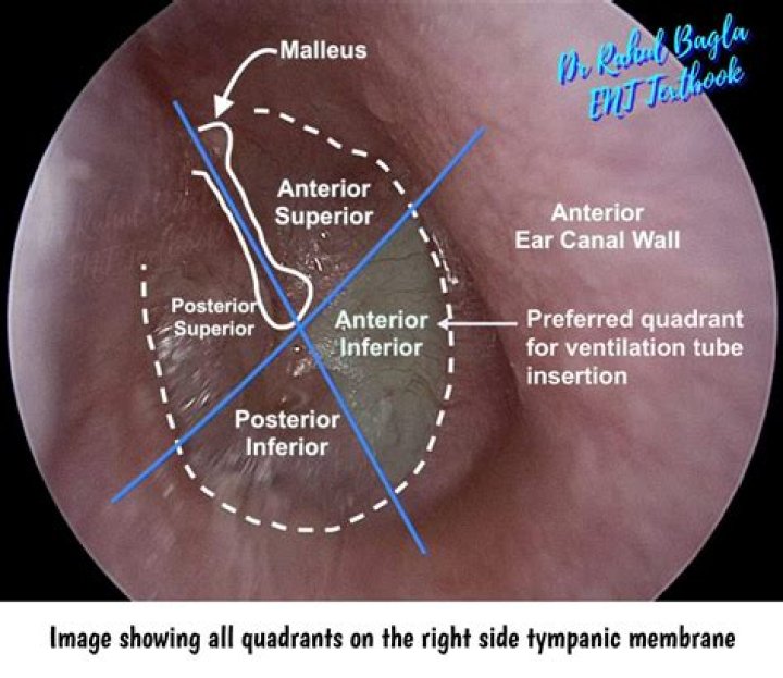 What is the surgical repair of the tympanic membrane?