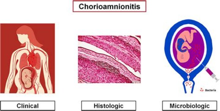 What is the treatment for chorioamnionitis?