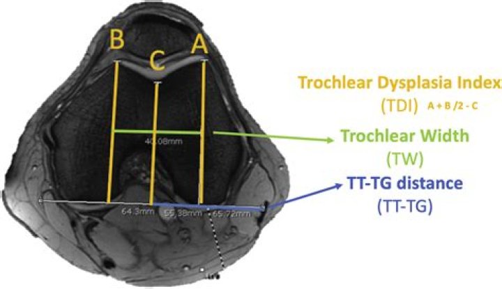 What is tibial tubercle Trochlear groove distance?