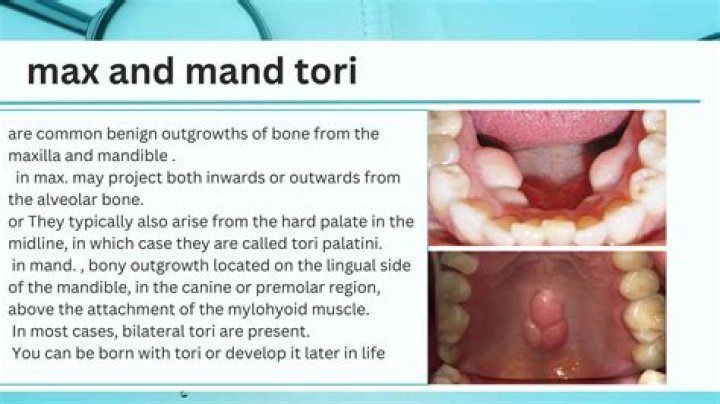 Why do you get Torus Mandibularis?