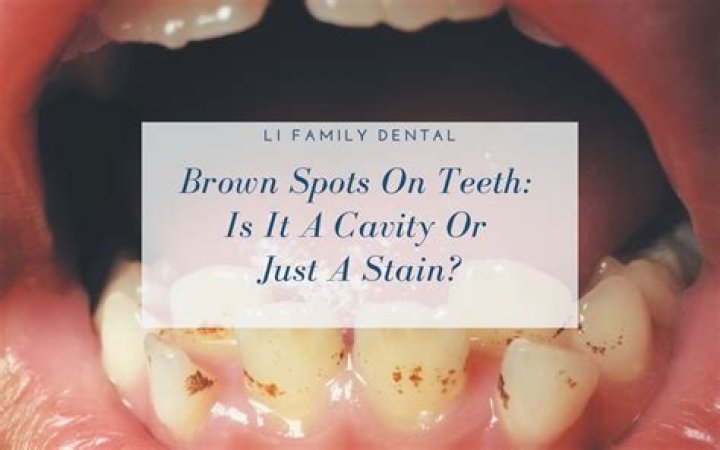 Why does my child have brown stains on teeth?