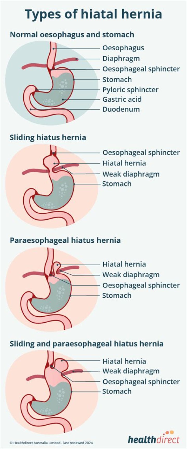 Why is it called a hiatus hernia?